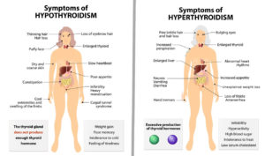 hypothyroidism vs hyperthyroidism, symptoms compared