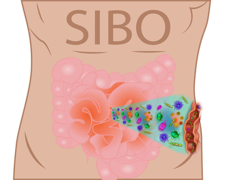 animation of Small Intestinal Bacterial Overgrowth